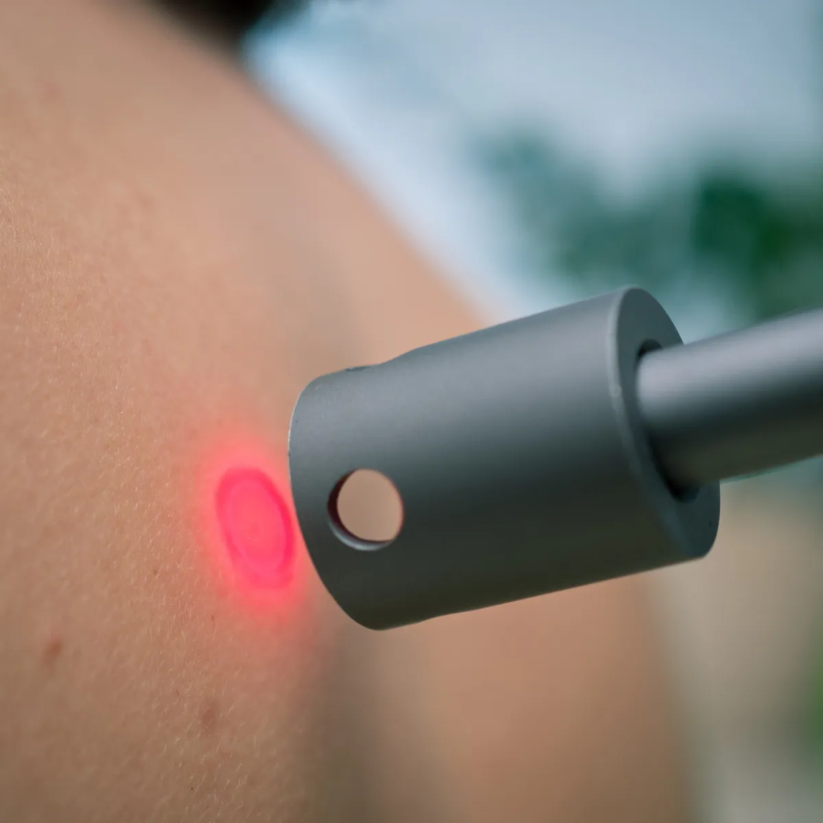 Graues Lasertherapie-Gerät behandelt Haut mit rotem Lichtstrahl. Nahaufnahme der Spitze, die ein hellrotes, kreisförmiges Lichtfeld auf leicht behaarte Haut projiziert. Fokus auf präziser Anwendung der Lasertherapie.