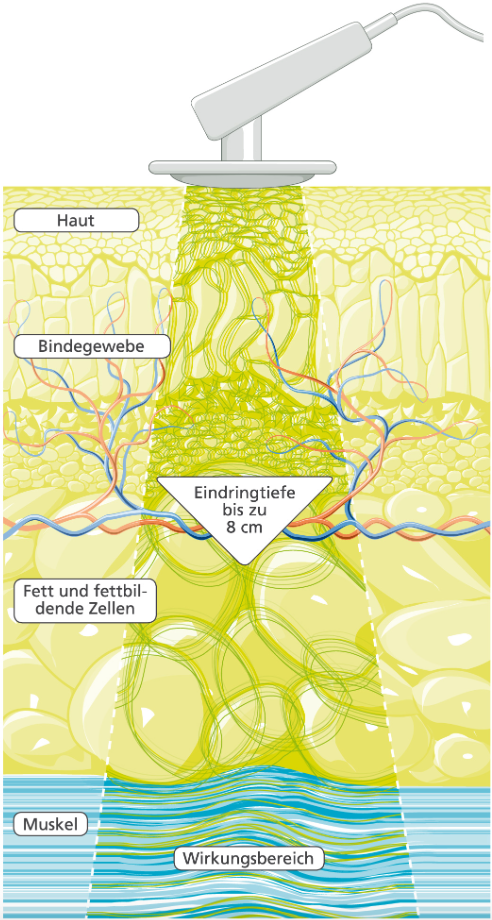 Schema della terapia a oscillazione profonda: impulsi elettrostatici emessi da un manipolo penetrano fino a 8 cm in pelle, tessuto connettivo, cellule adipose e muscoli, ottenendo un effetto biologico profondo.